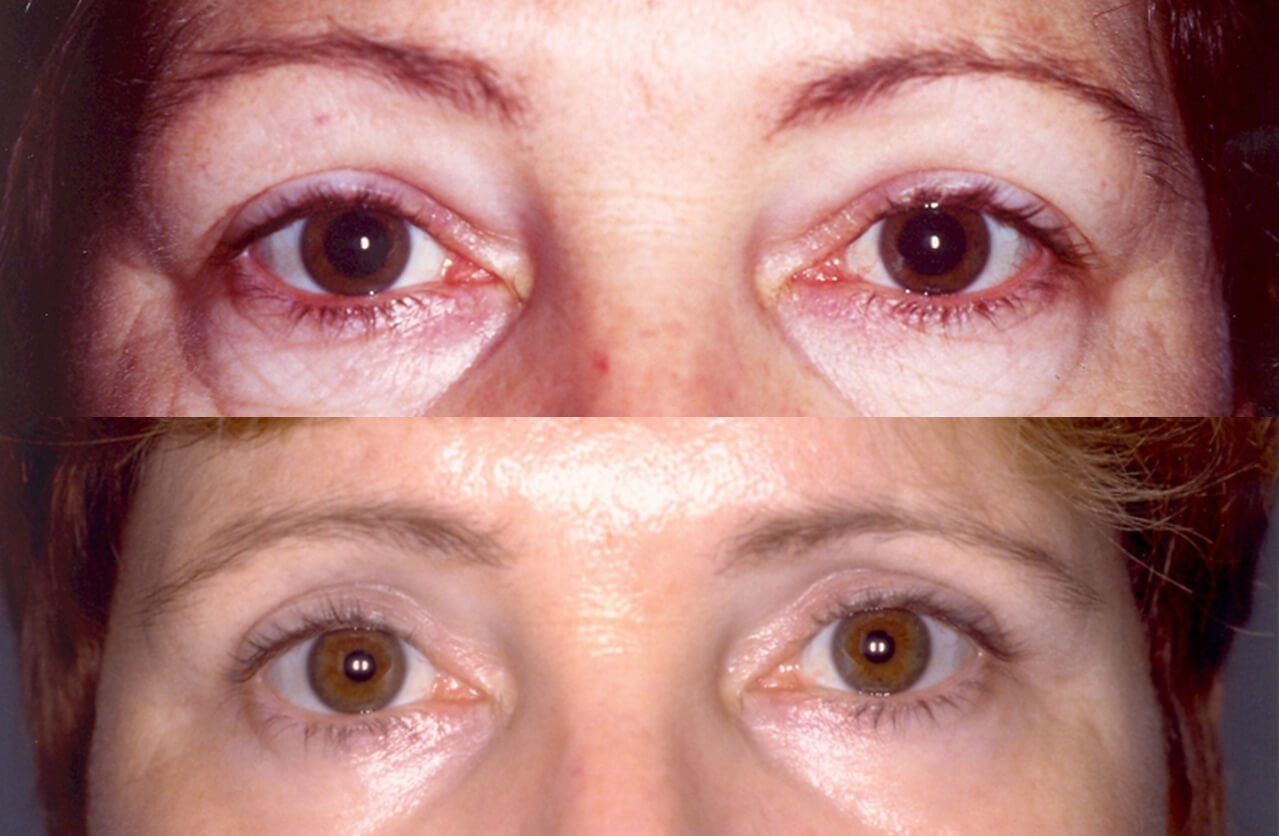 Before and 3 Months After Upper & Lower Eyelid Surgery, Laser Resurfacing Under Eyes, and Chemical Peel to Rest of Face