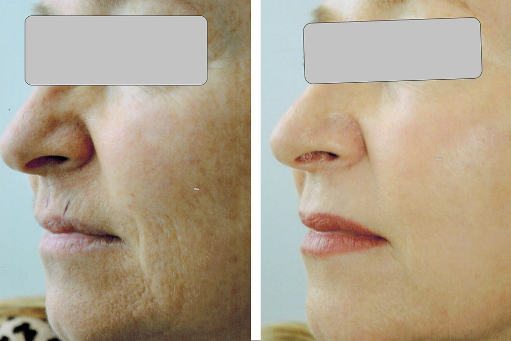 Full Face Laser Resurfacing