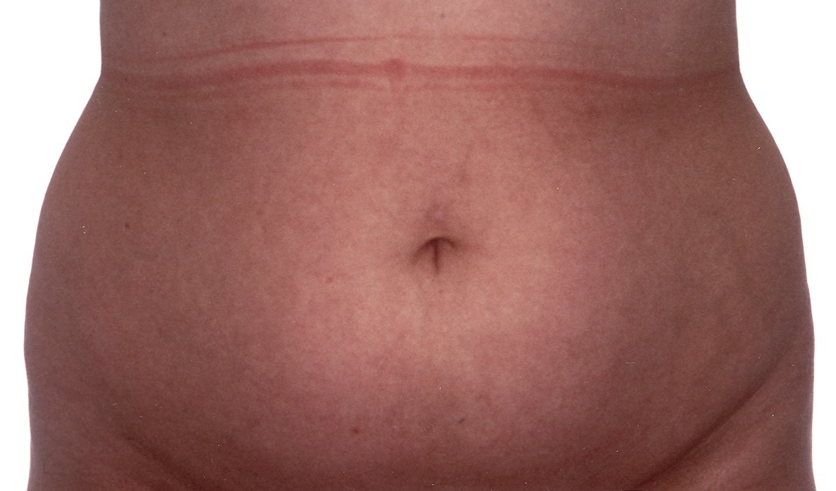Abdomen Liposuction - Australia Cosmetic Clinics
