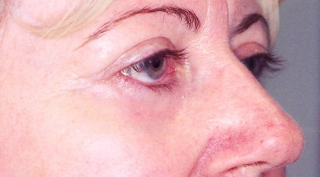 After Upper Eyelid Surgery