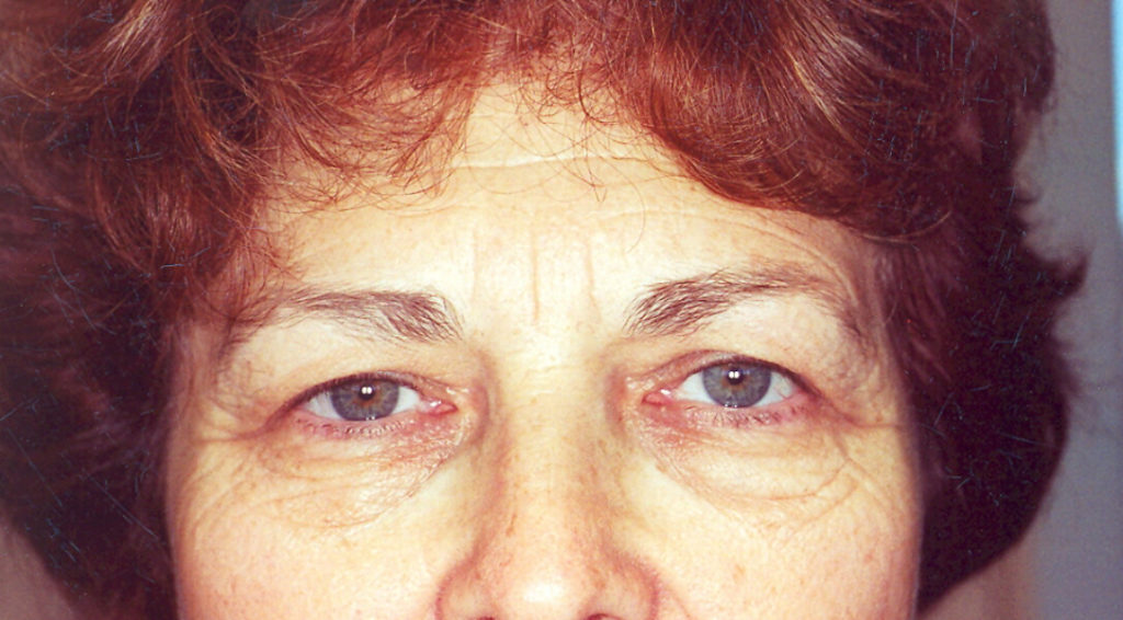 Before Laser Upper Eyelid Surgery