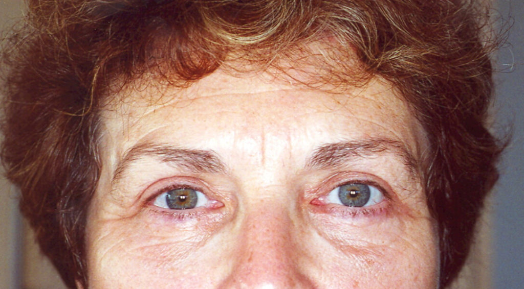 After Laser Upper Eyelid Surgery