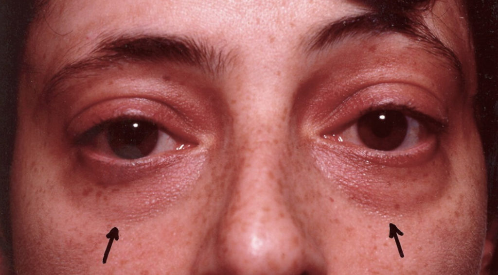 Before Lower Eyelid Surgery