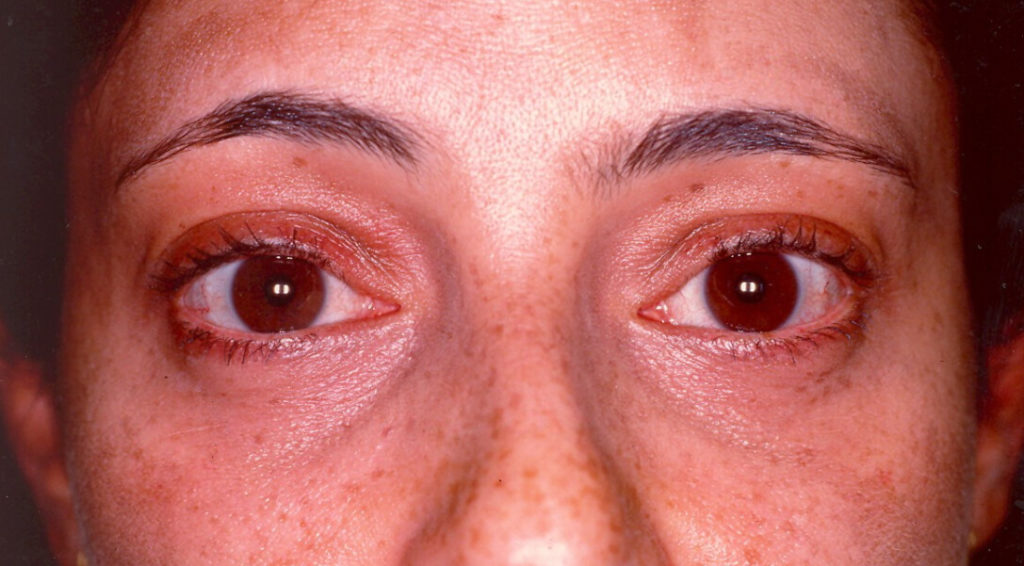 After Lower Eyelid Surgery