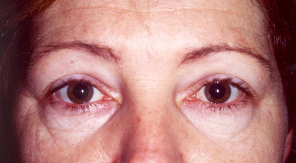 Before Upper and Lower Laser Eyelid Surgery