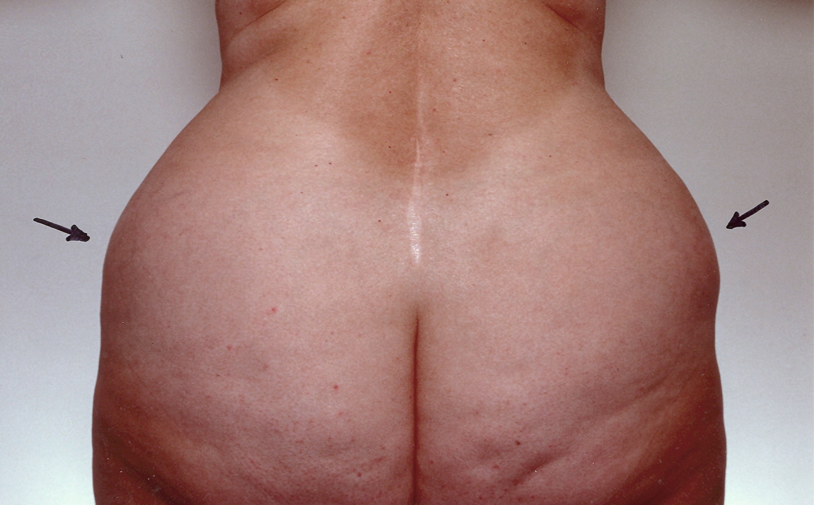 Liposuction Sydney