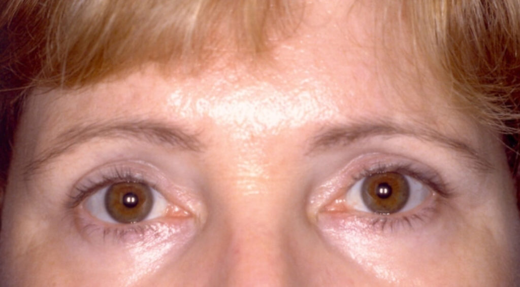 After Upper and Lower Laser Eyelid Surgery