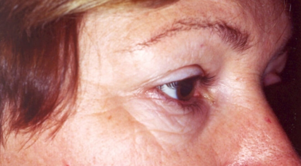 Before Upper and Lower Laser Eyelid Surgery