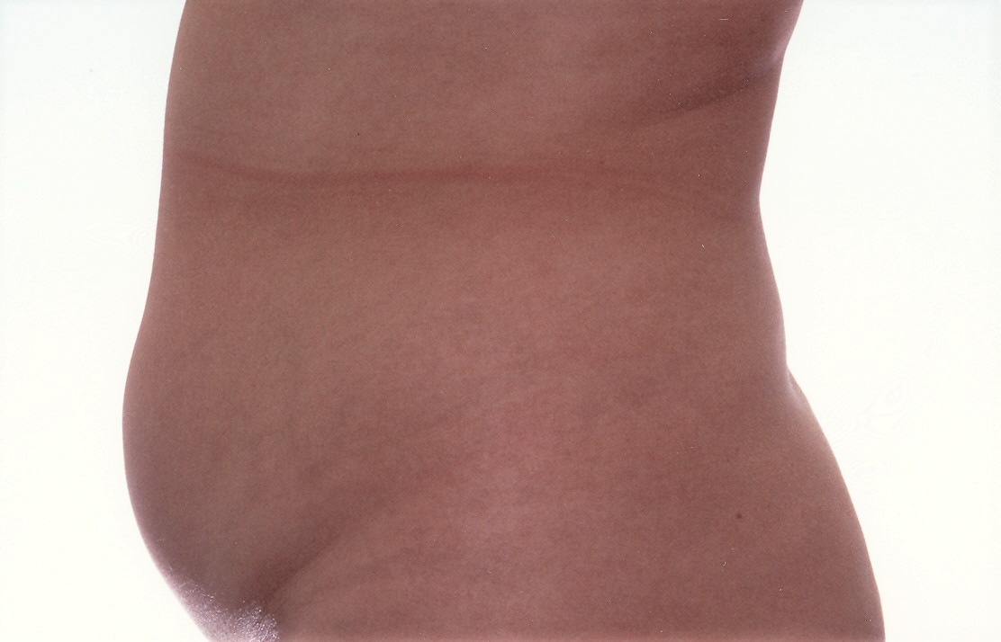 Sydney Liposuction