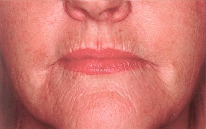 Before Ultrapulse CO2 Laser