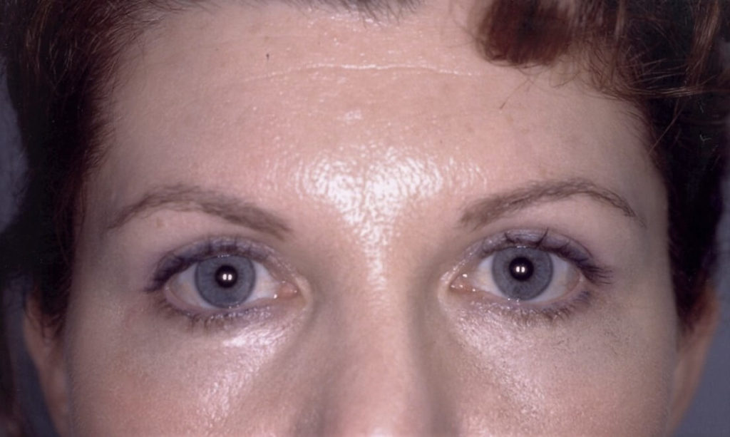 Eyelid Surgery Sydney