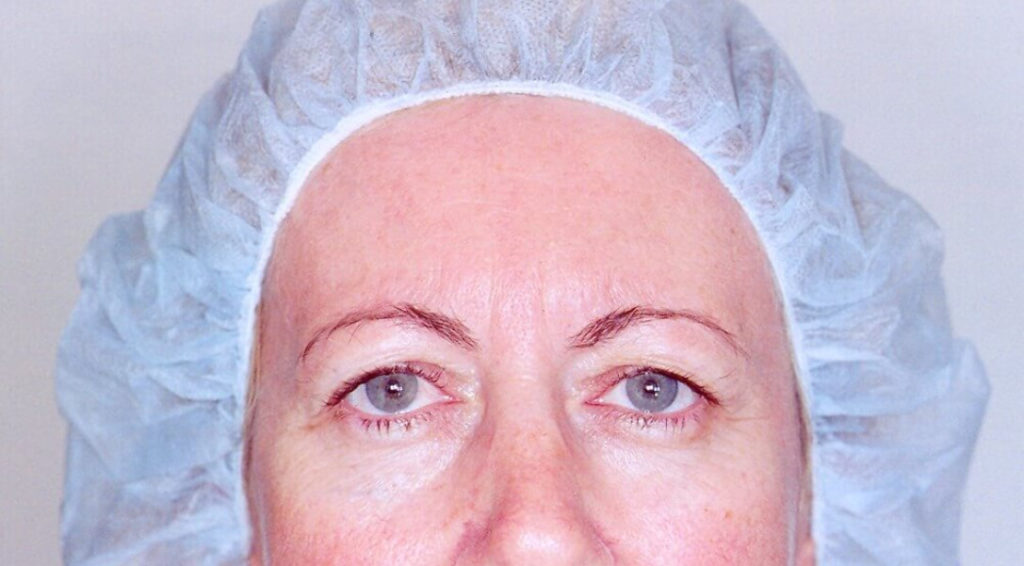 Eyelid Surgery Before and After