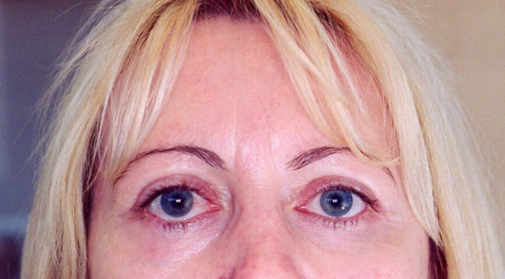 Eyelid Surgery