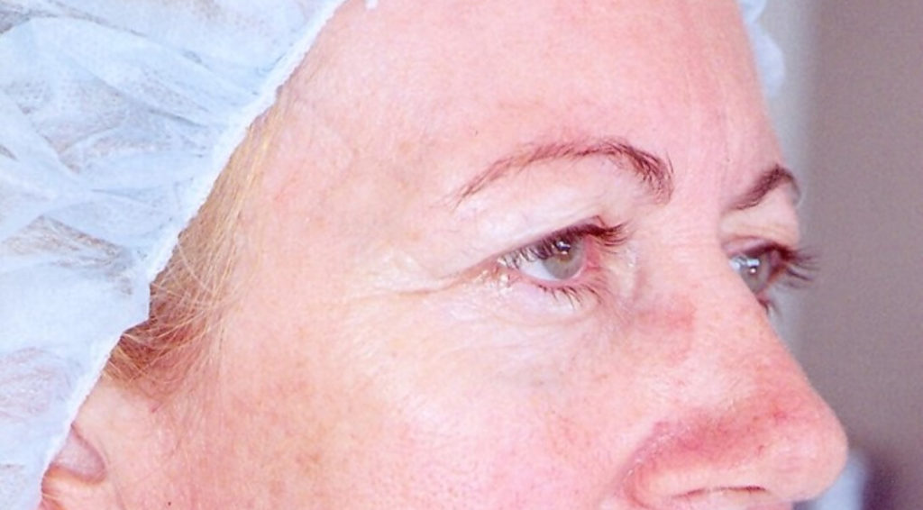 Before Upper Eyelid Surgery