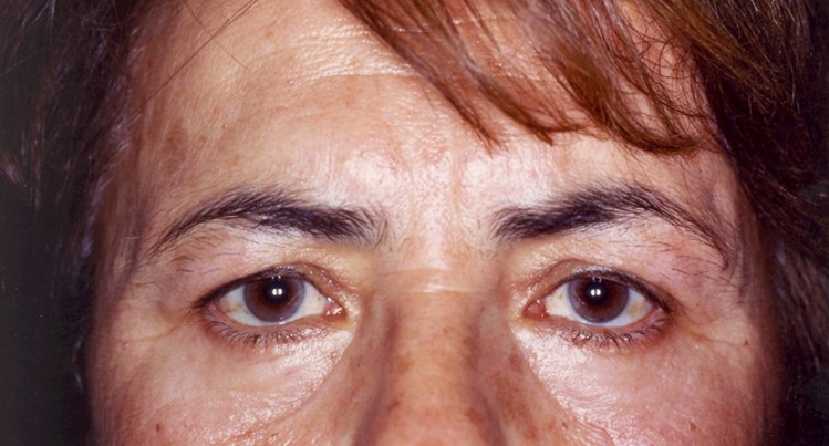 After Laser Lower Eyelid Surgery