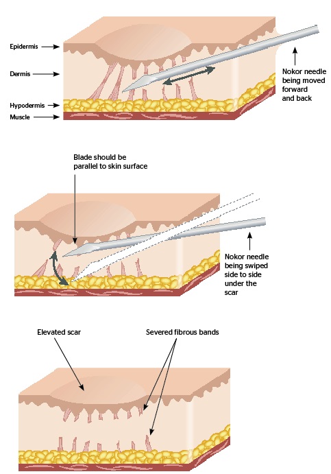 Acne Scarring Treatment