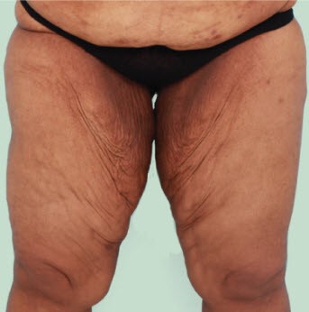 If you get liposuction of the inner thighs will you need a compression  garment for my thigh areas?