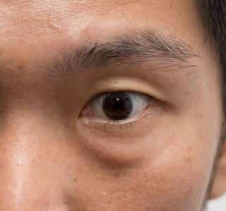 Eyelid Surgery