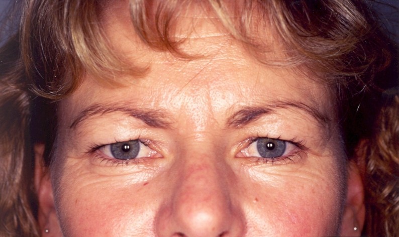 Eyelid Surgery Before and After