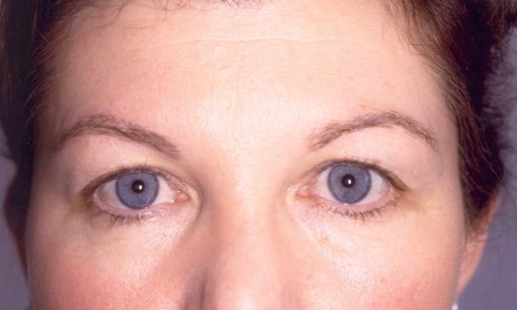 Eyelid Surgery Before and After