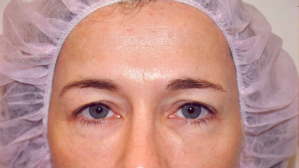 Eyelid Surgery Before and After