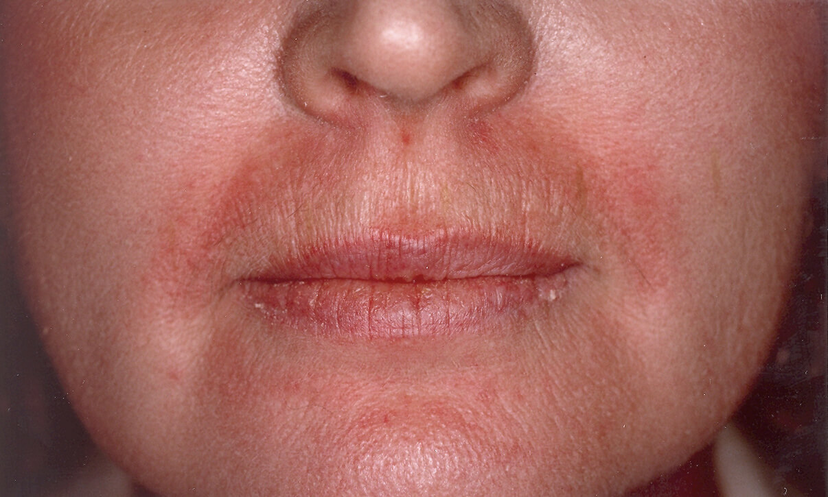 Upper Lip Laser