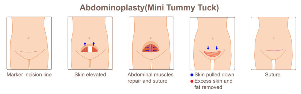 Mini Tummy Tuck Surgery Technique