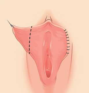 Labiaplasty Surgery - Trim Technique