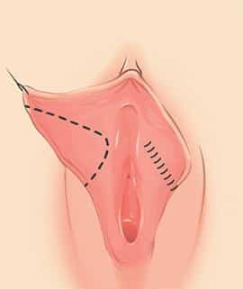 Labiaplasty Surgery-Wedge Excision