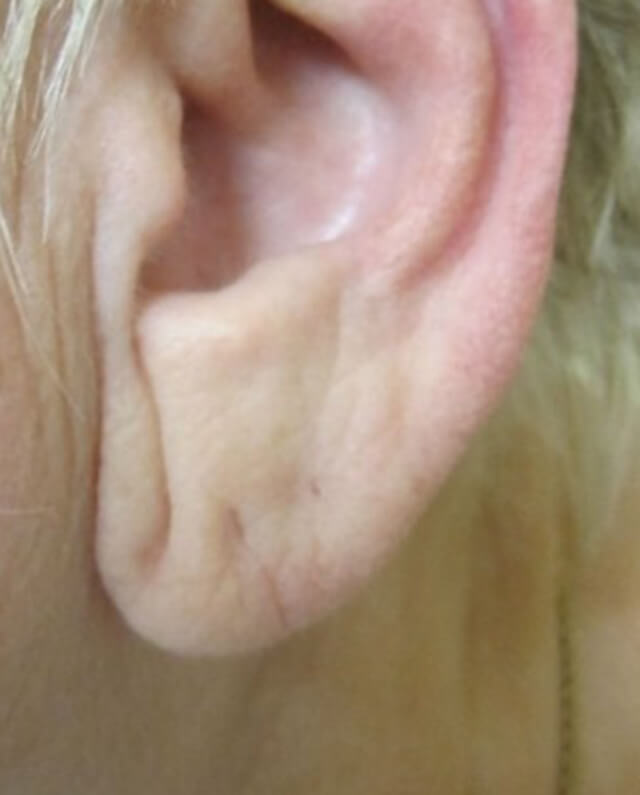 Skin infection sale ear lobe