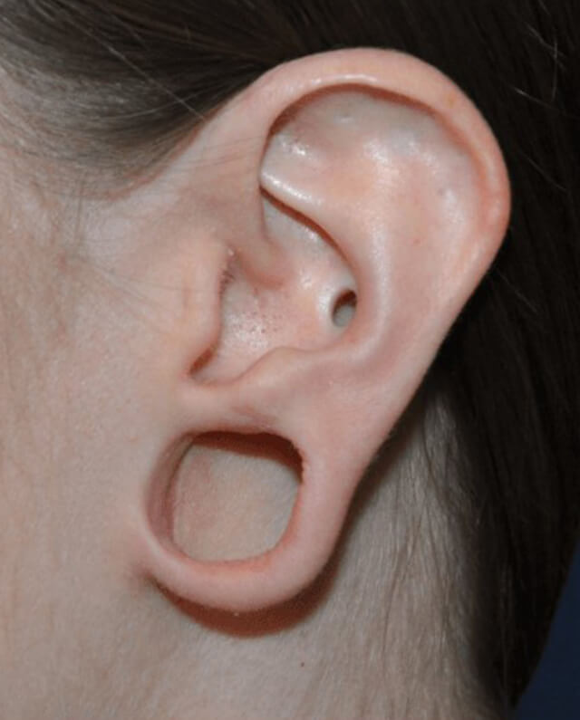 Ear Lobe Surgery