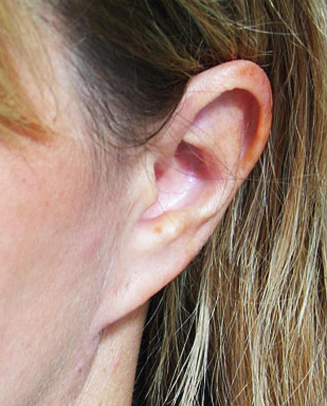 Ear Lobe Surgery