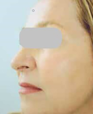 Laser Resurfacing