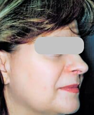 Laser Skin Resurfacing