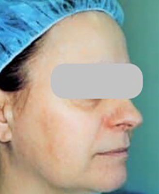 Laser Skin Resurfacing