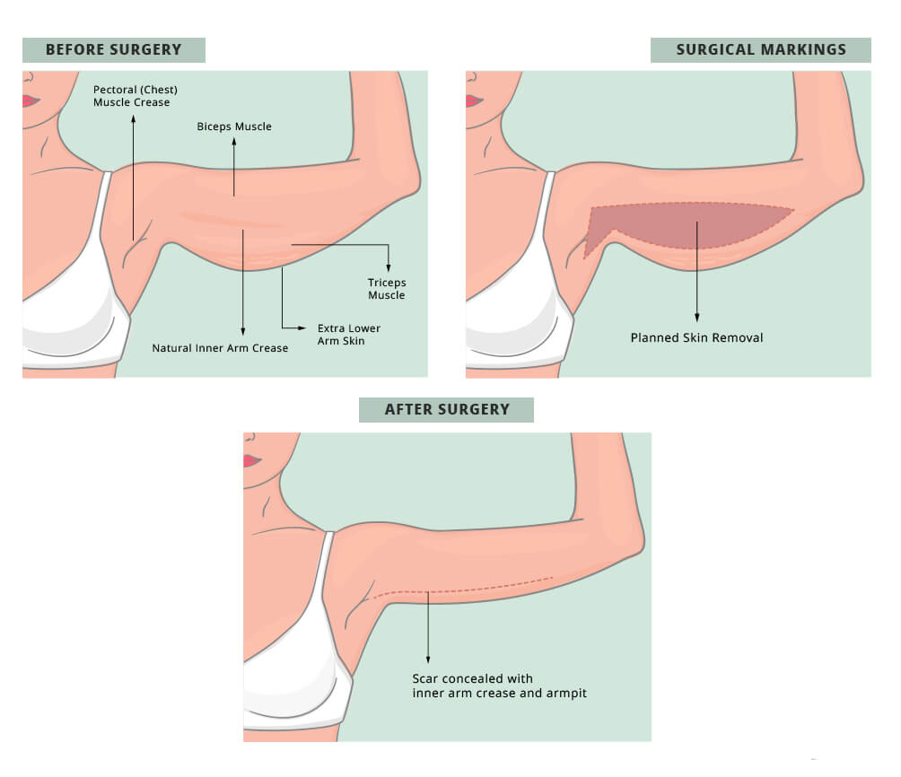 Arm Lift Surgery Sydney