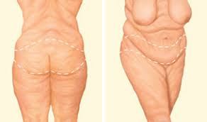 Body Lift Surgery