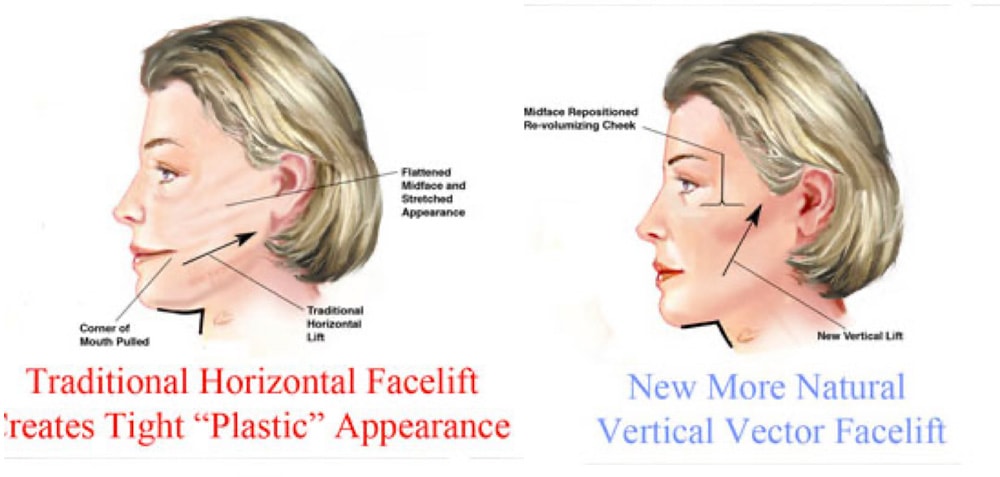 Traditional vs Deep Plane Facelift