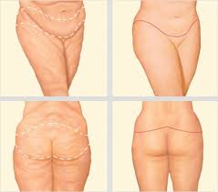 Circumferential Abdominoplasty