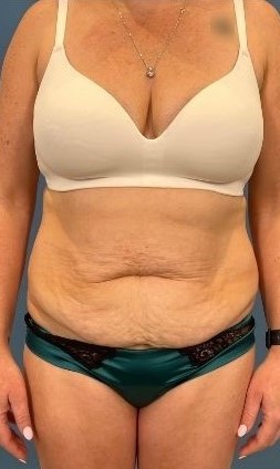 Abdominoplasty Sydney