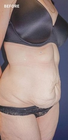 Before Tummy Tuck Sydney