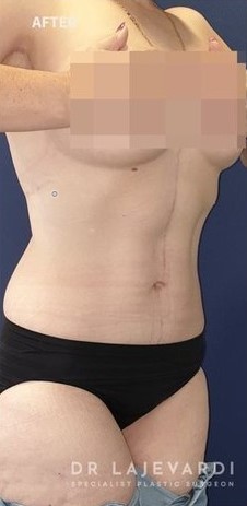 6 Months After Tummy Tuck Surgery