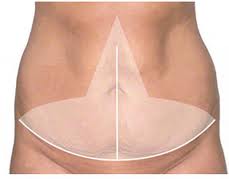 Fleur de Lis Tummy Tuck Surgery