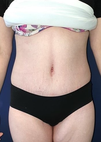 6 Months After Body Lift Sydney