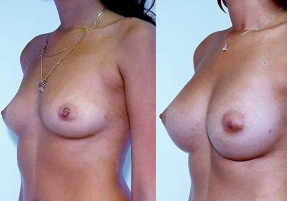 Before & 4 Months After Breast Augmentation