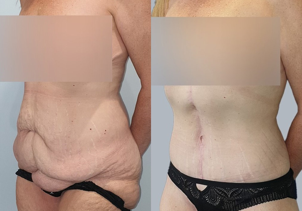 Before & 4 Months After Corset Tummy Tuck Surgery + 360° Liposuction Fat Grafting to Buttocks