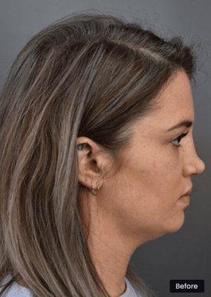 Revision Rhinoplasty Sydney