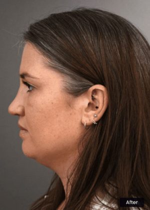 6 Months After Revision Rhinoplasty Surgery Sydney