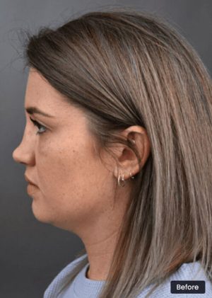 Revision Rhinoplasty Surgery Sydney