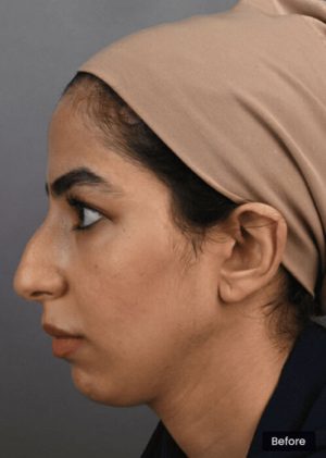 Nose Surgery Sydney